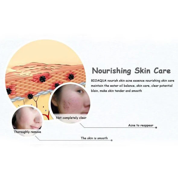 BIOAQUA Acne Rejuvenation Serum - Anti-Acne & Skin Renewal Treatment - 30ml